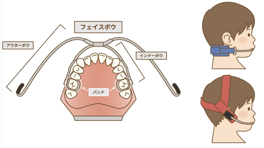 ヘッドギア
